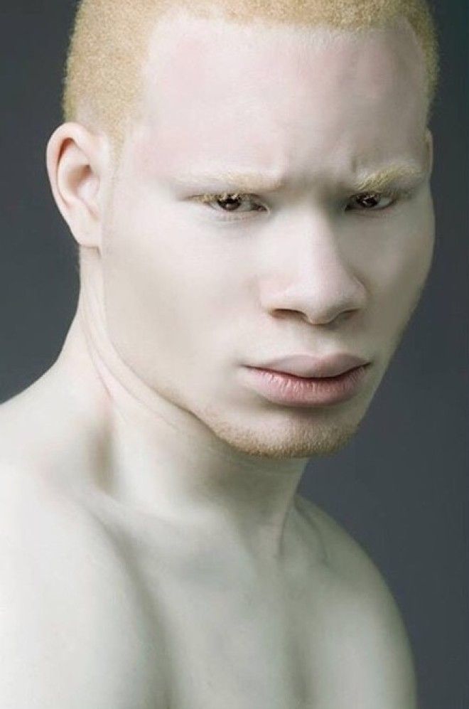 Как выглядят альбиносы разных национальностей и рас 45