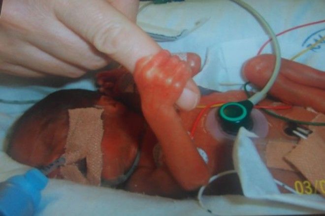 Связаны судьбой: чудо-близняшки, которые родились с перерывом в 87 дней 30