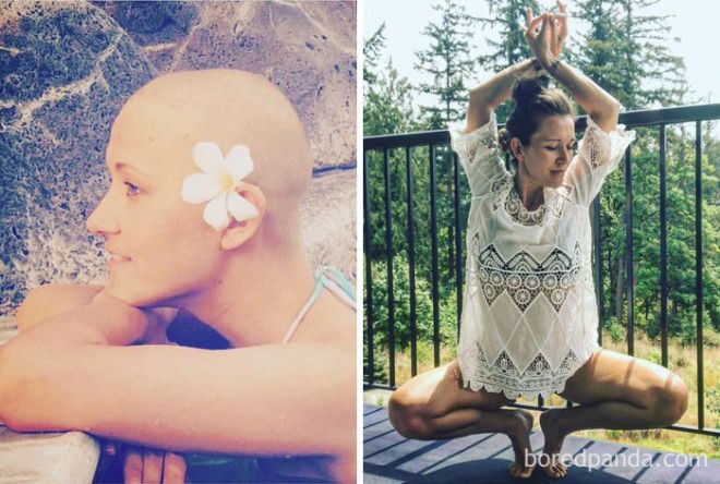 Люди, которые победили рак, в фотографиях до и после 43