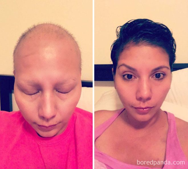 Люди, которые победили рак, в фотографиях до и после 46
