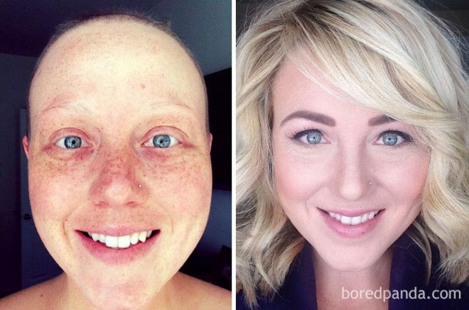 Люди, которые победили рак, в фотографиях до и после 40