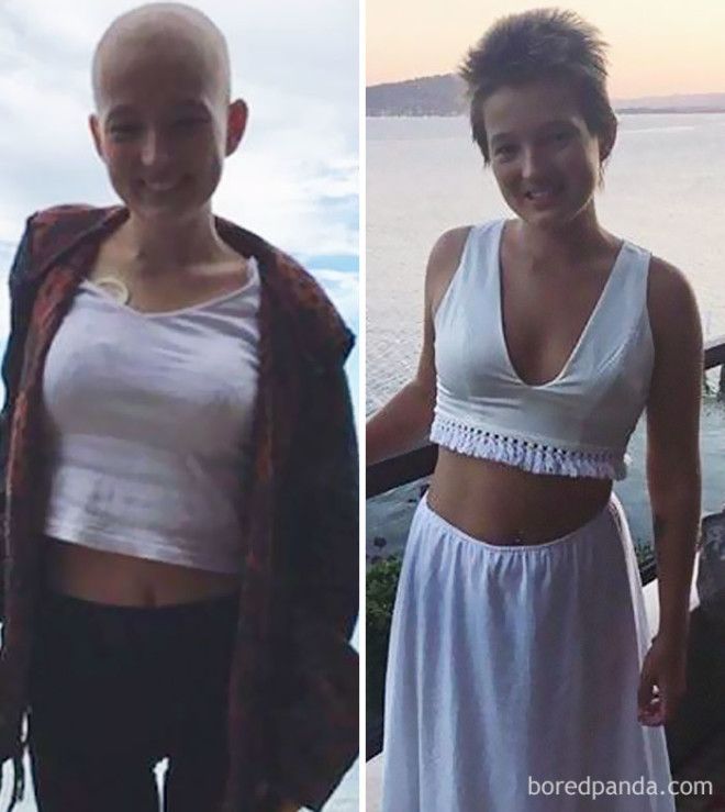 Люди, которые победили рак, в фотографиях до и после 44