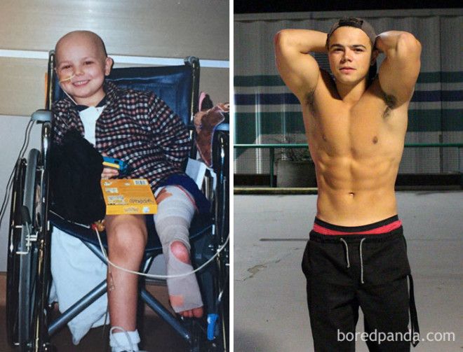 Люди, которые победили рак, в фотографиях до и после 47