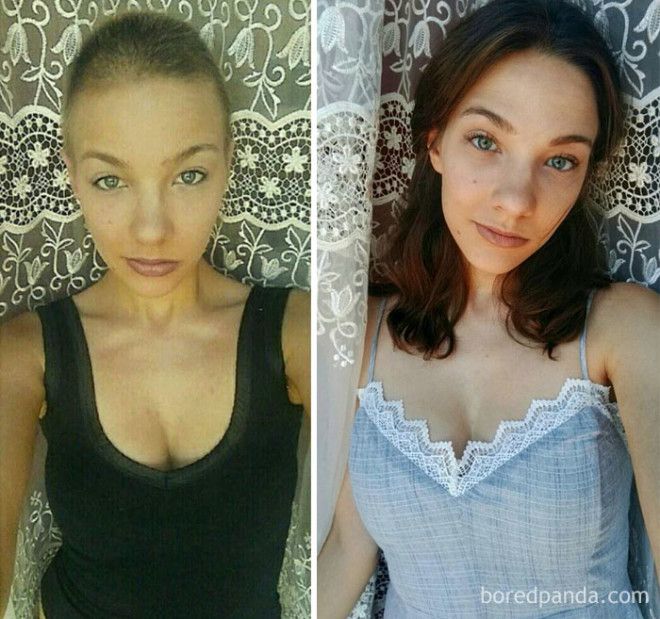 Люди, которые победили рак, в фотографиях до и после 26