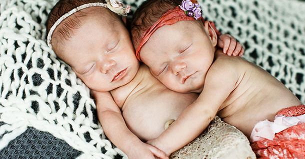 Эти близнецы покорили мир одним лишь снимком при рождении 22
