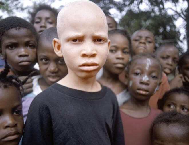 В Африке бытует мнение, что части тела альбиносов имеют магические свойства и могут служить талисманами... Ты знал?