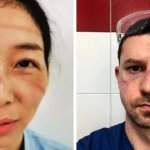 Врачи показали, как выглядят их лица после смен в больницах, где они помогают пациентам с коронавирусом