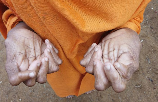 Женщина, у которой 31 палец на руках и ногах 42