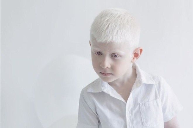 Фотограф показывает гипнотизирующую красоту людей-альбиносов (11 фото) 42