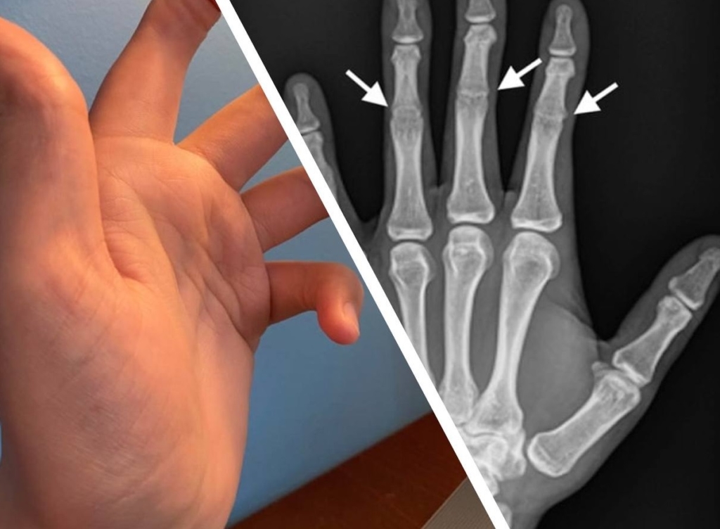 Парень показал свою руку без средних суставов на пальцах и люди не верят, что это возможно, но автор рассказал каково это 10