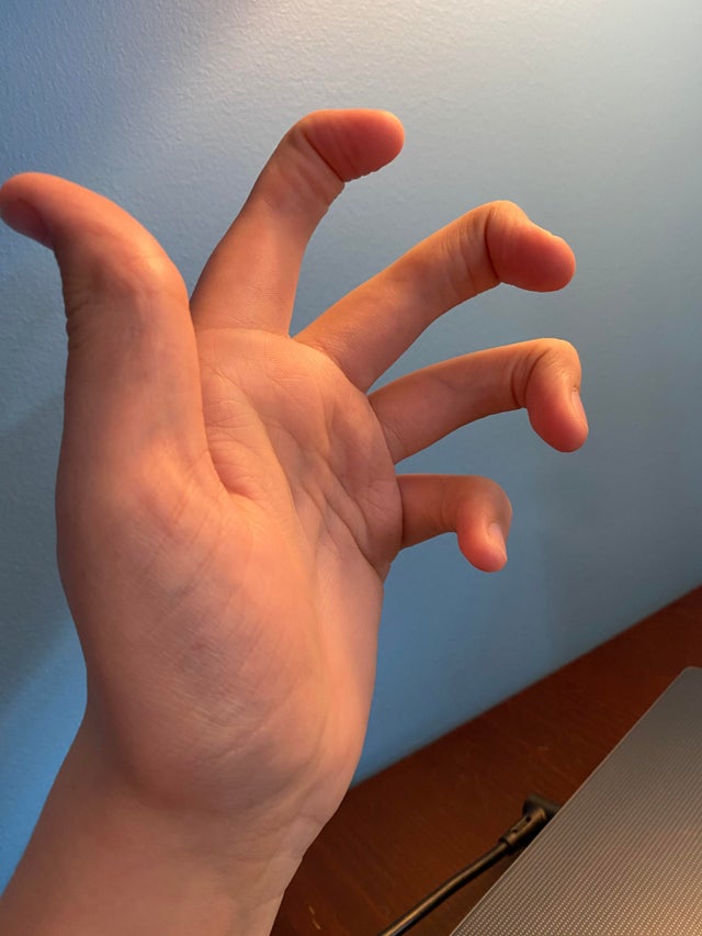 Парень показал свою руку без средних суставов на пальцах и люди не верят, что это возможно, но автор рассказал каково это 11