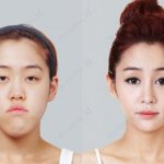 Чудеса пластики: 20 невероятных преображений южнокорейских женщин