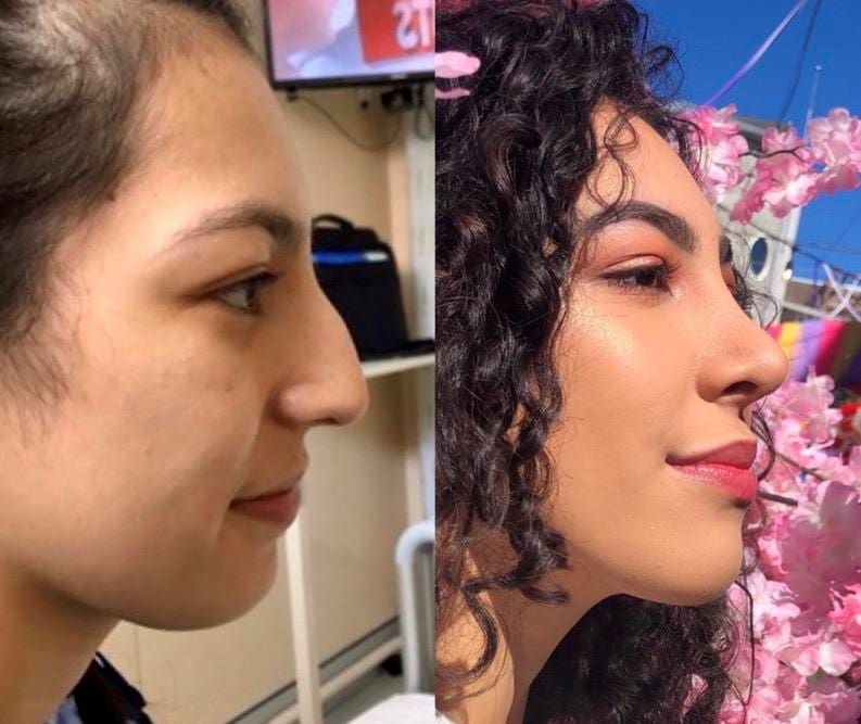 16 фотографий людей до и после того, как они решили исправить свою внешность с помощью пластической хирургии 52