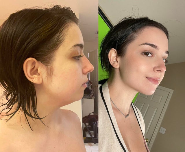 16 фотографий людей до и после того, как они решили исправить свою внешность с помощью пластической хирургии 55