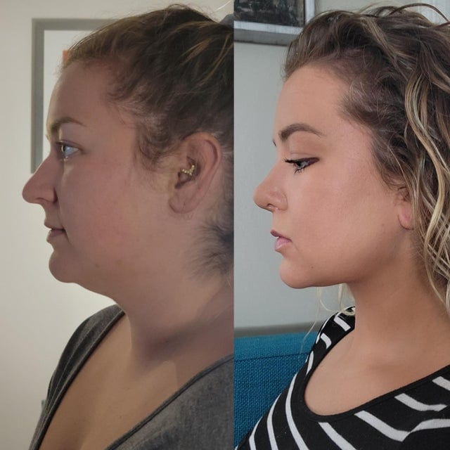 16 фотографий людей до и после того, как они решили исправить свою внешность с помощью пластической хирургии 56