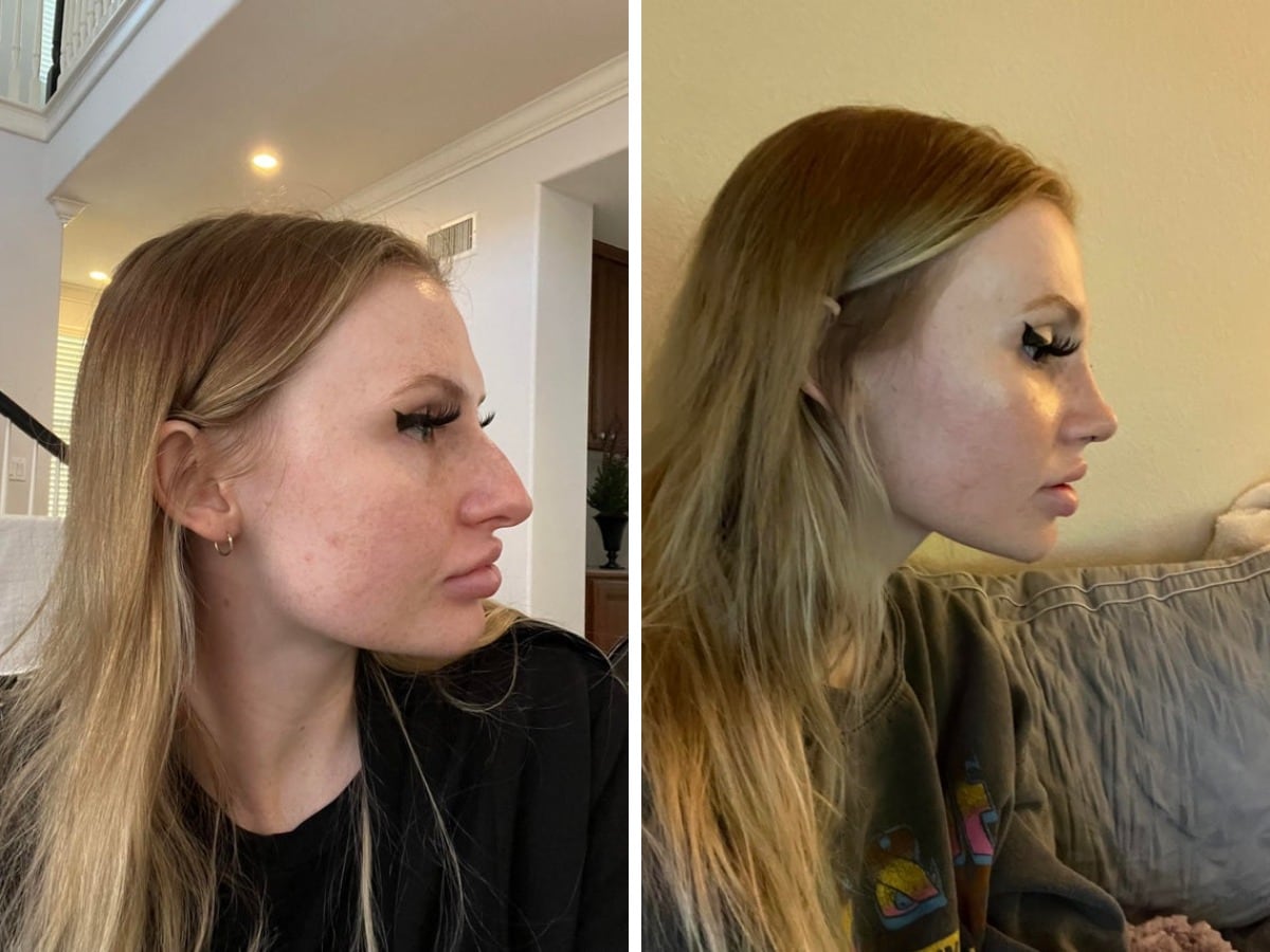 16 фотографий людей до и после того, как они решили исправить свою внешность с помощью пластической хирургии 58