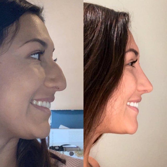 16 фотографий людей до и после того, как они решили исправить свою внешность с помощью пластической хирургии 59