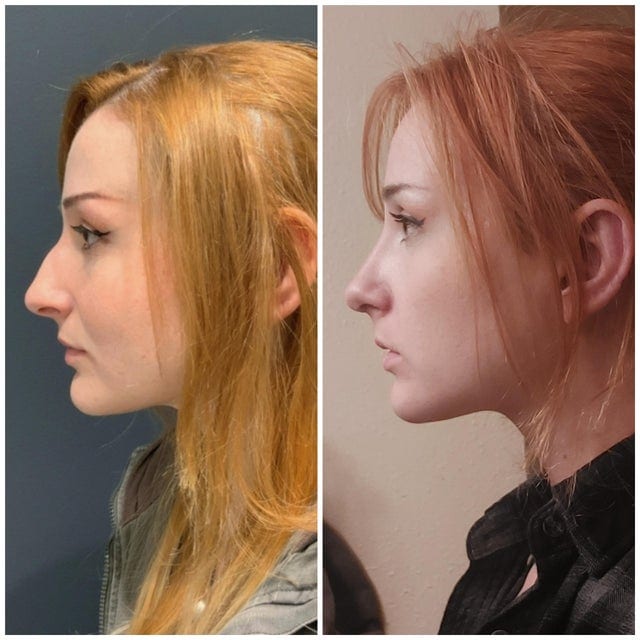 16 фотографий людей до и после того, как они решили исправить свою внешность с помощью пластической хирургии 65