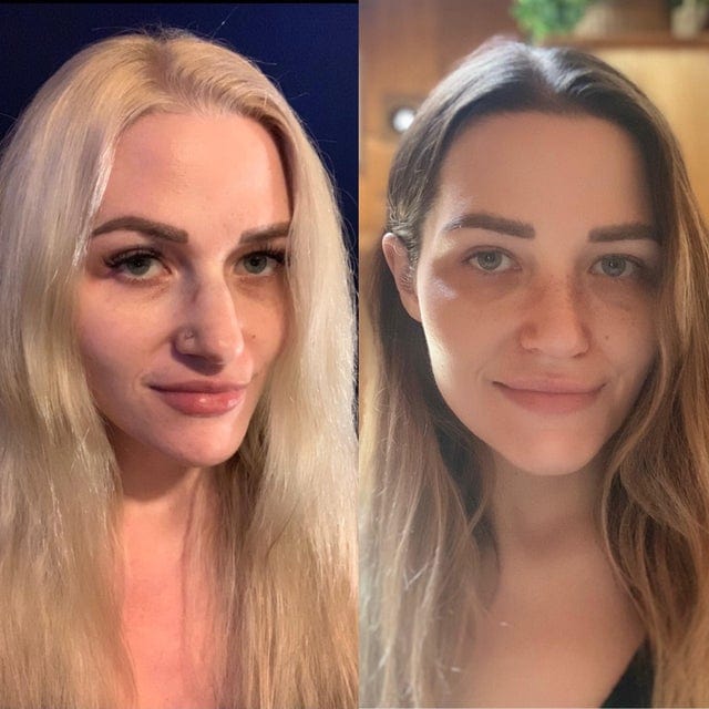 16 фотографий людей до и после того, как они решили исправить свою внешность с помощью пластической хирургии 66