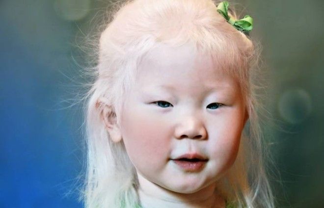Как выглядят альбиносы разных национальностей и рас 41