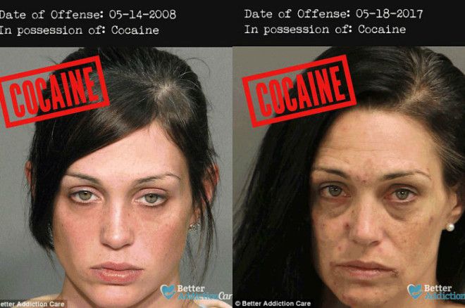 Лица наркозависимых до и после: как запрещенные вещества влияют на внешность 28