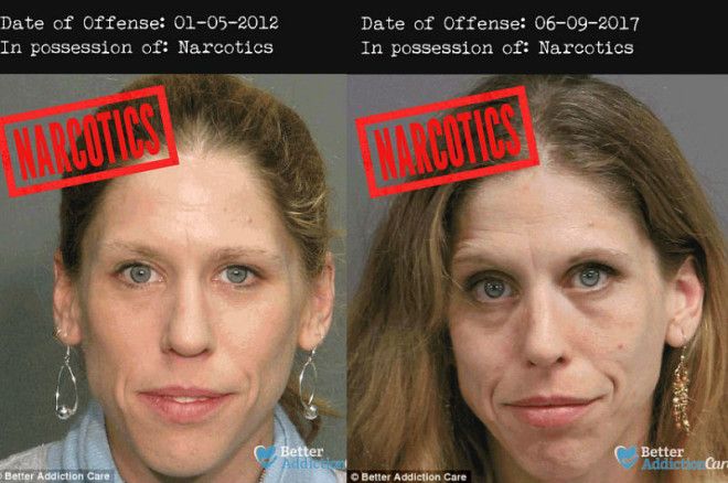 Лица наркозависимых до и после: как запрещенные вещества влияют на внешность 27
