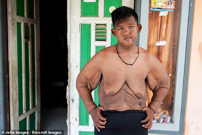 Самый толстый мальчик в мире, который весил 192 кг, похудел 44