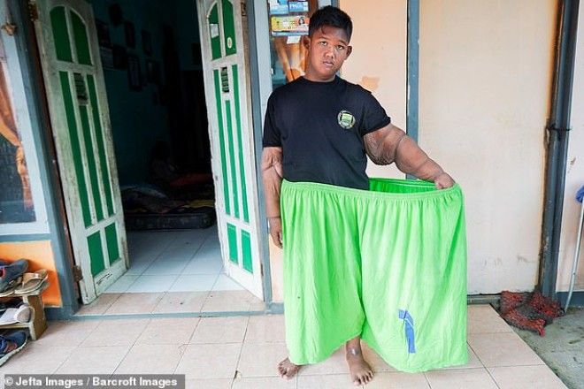 Самый толстый мальчик в мире, который весил 192 кг, похудел 39