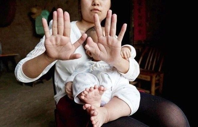 В Китае родился мальчик у которого 31 палец 15