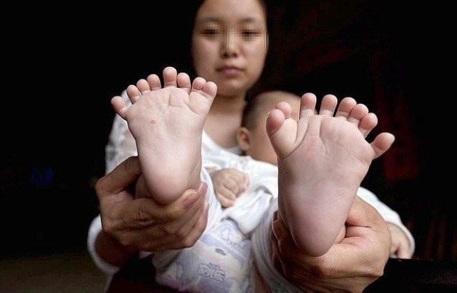 В Китае родился мальчик у которого 31 палец 14