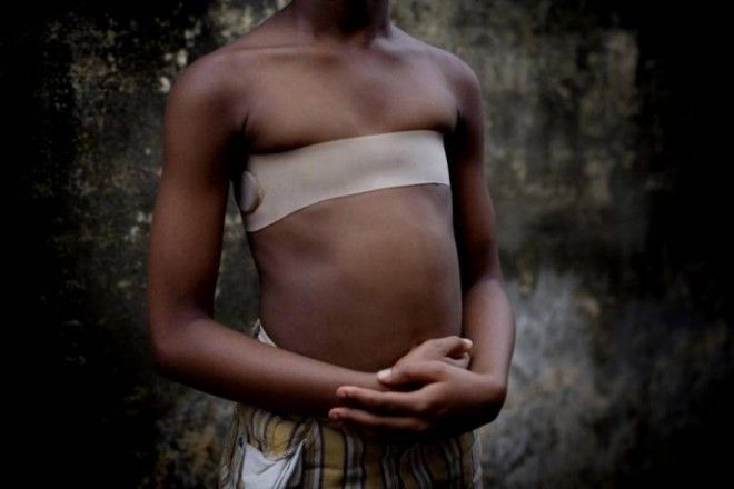 НА 2300Утюжка груди еще одна шокирующая традиция стран Африки